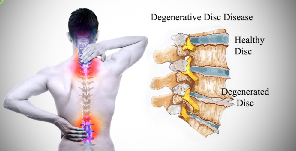 Joint wear & tear : Degenerative changes